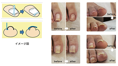 巻き爪ケアについて ネイルサロンtricia トリシア 表参道 銀座ネイルサロン