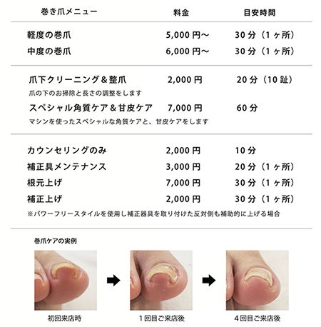 巻き爪ケアについて ネイルサロンtricia トリシア 表参道 銀座ネイルサロン